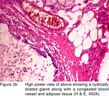 Brunner s gland hamartoma and hyperplasia