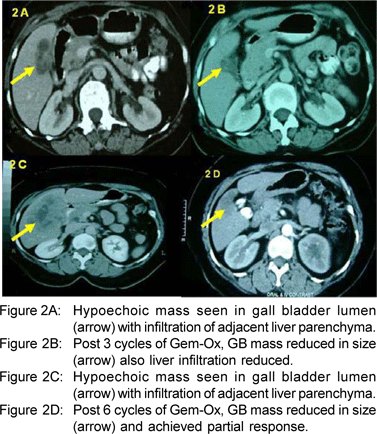 Radical Cholecystectomy