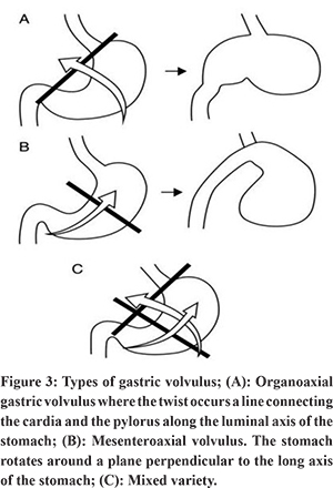 paraesophageal hernia with gastric volvulus