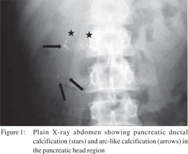 chronic pancreatitis x ray
