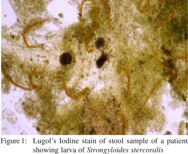 strongyloides in stool