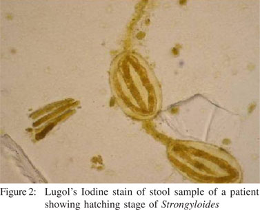 strongyloides in stool