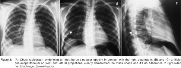 Pneumoperitoneum, Artificial