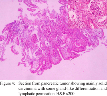 Synchronous adenocarcinoma of the gall bladder and pancreas in a young ...